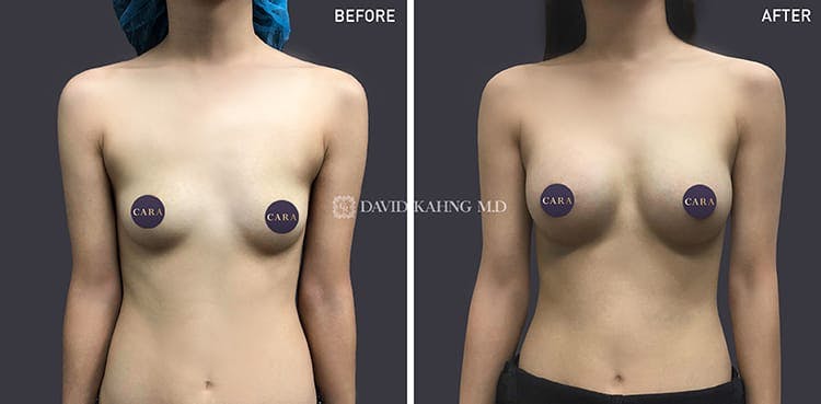 Breast Augmentation Gallery - Patient 108464493 - Image 1