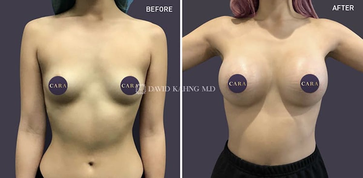 Breast Augmentation Before & After Gallery - Patient 108464494 - Image 1