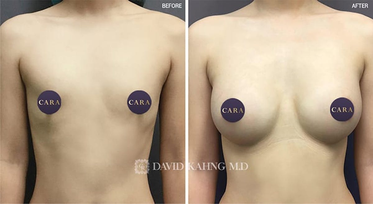 Breast Augmentation Before & After Gallery - Patient 108464496 - Image 1