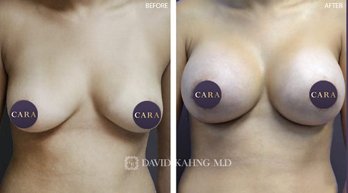 Breast Augmentation Before & After Gallery - Patient 108464497 - Image 1