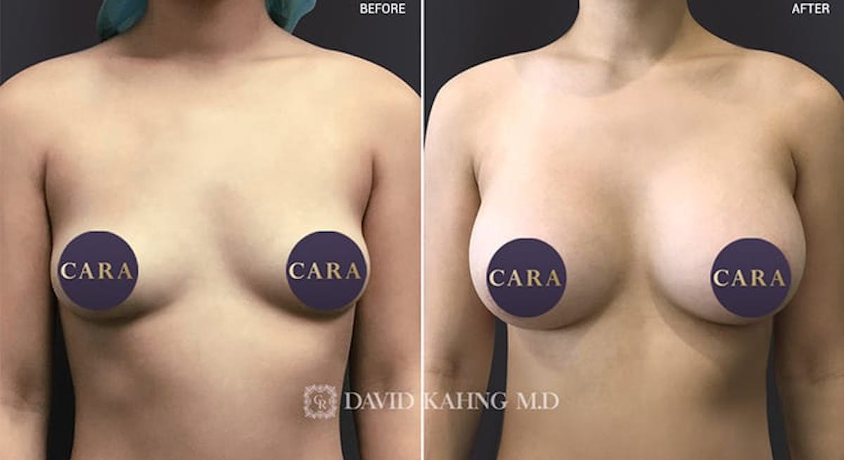 Breast Augmentation Before & After Gallery - Patient 108464498 - Image 1