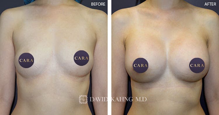 Breast Augmentation Before & After Gallery - Patient 108464499 - Image 1