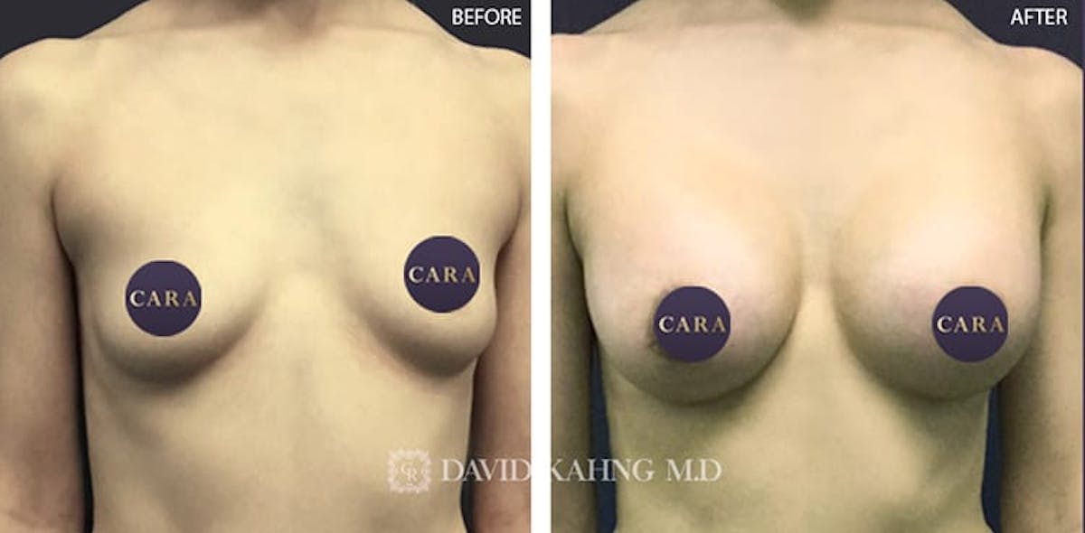 Breast Augmentation Before & After Gallery - Patient 108464500 - Image 1