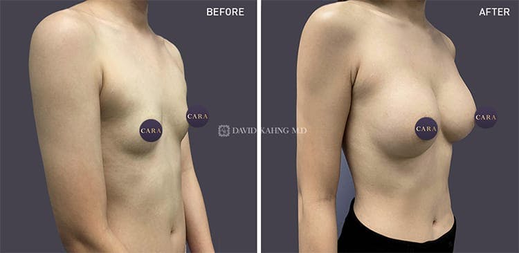 Breast Augmentation Before & After Gallery - Patient 108464469 - Image 1