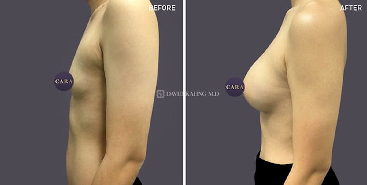 Breast Augmentation Before & After Gallery - Patient 108464473 - Image 1