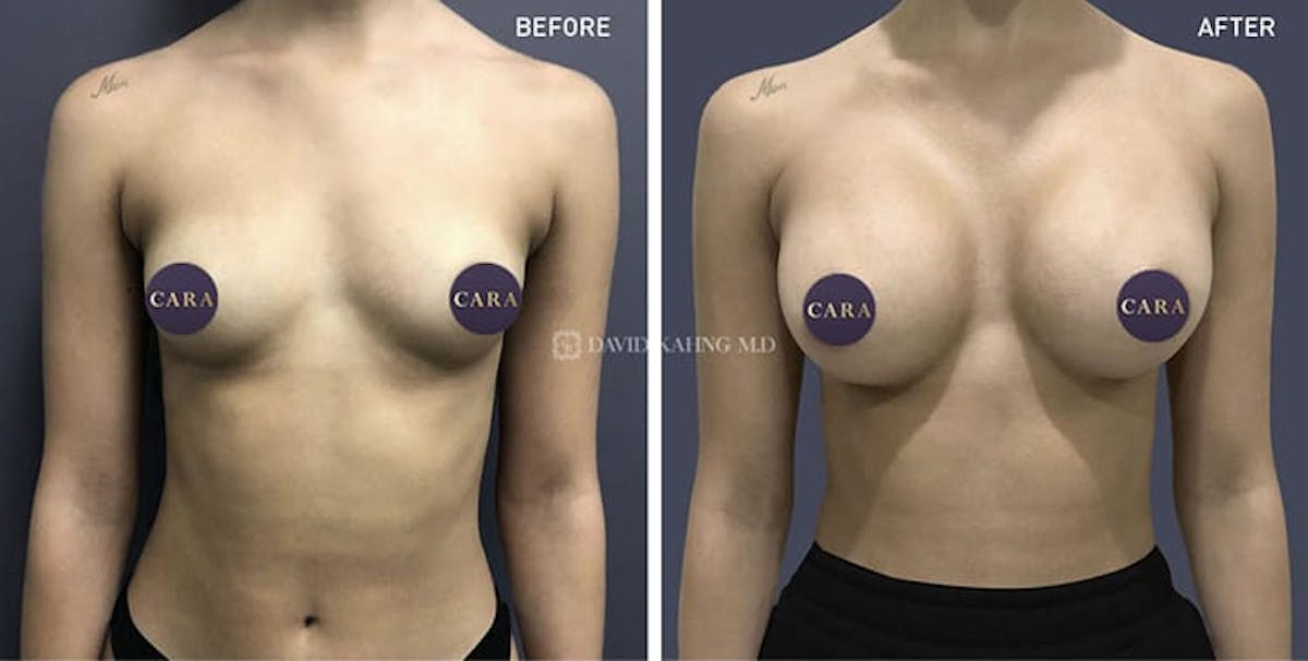 Breast Augmentation Before & After Gallery - Patient 108464470 - Image 1