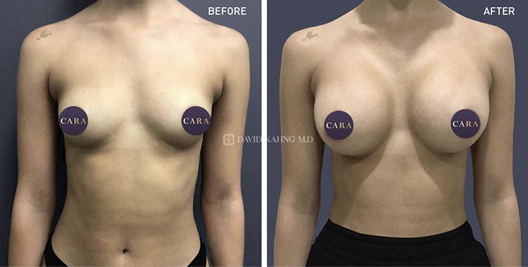 Breast Augmentation Gallery - Patient 108464470 - Image 1