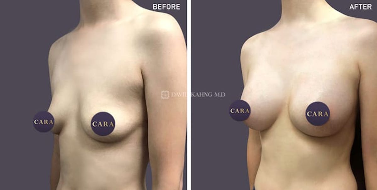 Breast Augmentation Before & After Gallery - Patient 108464471 - Image 1