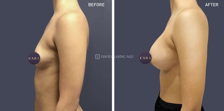 Breast Augmentation Gallery - Patient 108464472 - Image 1