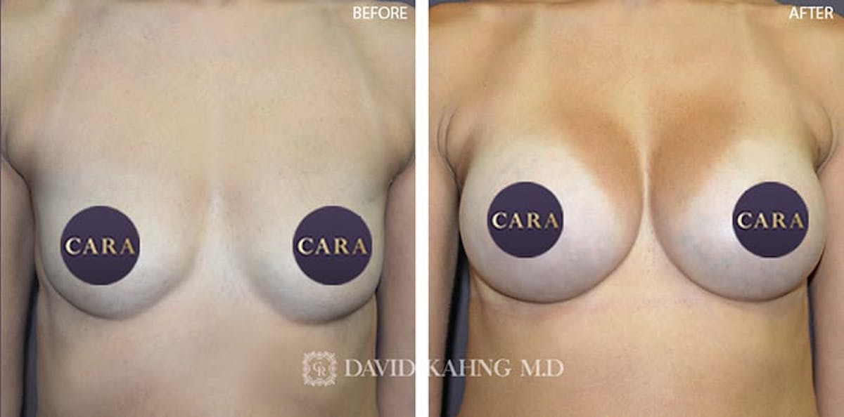 Breast Augmentation Before & After Gallery - Patient 108464479 - Image 1