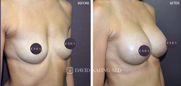 Breast Augmentation Gallery - Patient 108464479 - Image 1