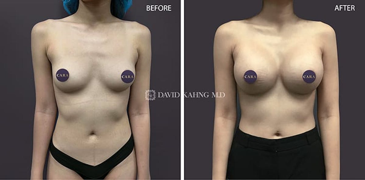 Breast Augmentation Before & After Gallery - Patient 108464481 - Image 1