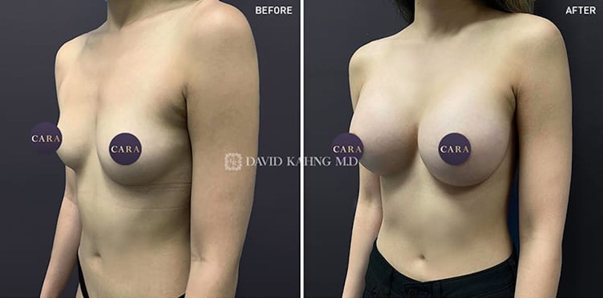 Breast Augmentation Before & After Gallery - Patient 108464481 - Image 2