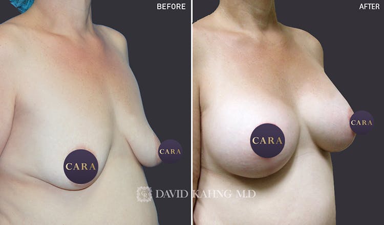 Breast Lift Before & After Gallery - Patient 108464673 - Image 1