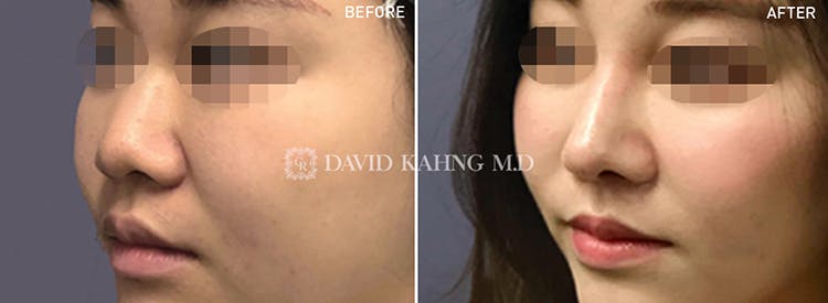 Rhinoplasty Before & After Gallery - Patient 108501446 - Image 1