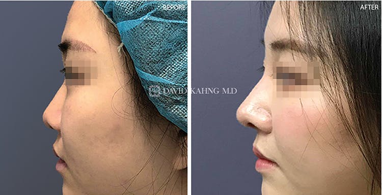 Rhinoplasty Before & After Gallery - Patient 108501446 - Image 2