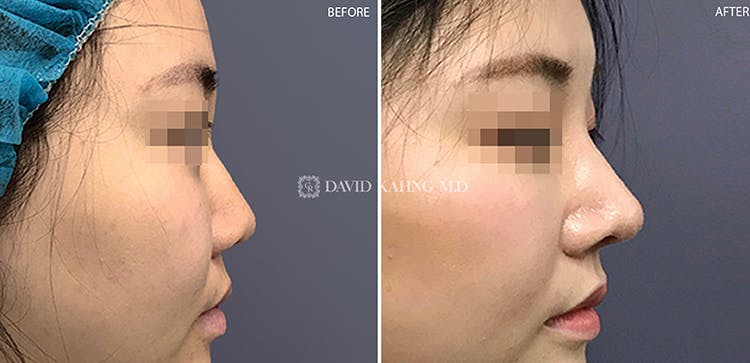 Rhinoplasty Before & After Gallery - Patient 108501446 - Image 3