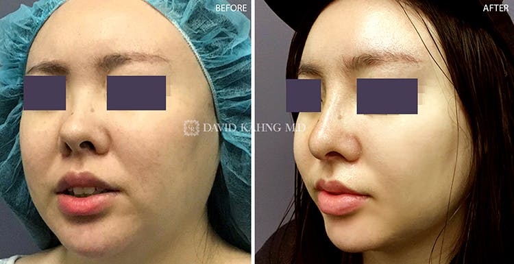 Rhinoplasty Before & After Gallery - Patient 108501447 - Image 1