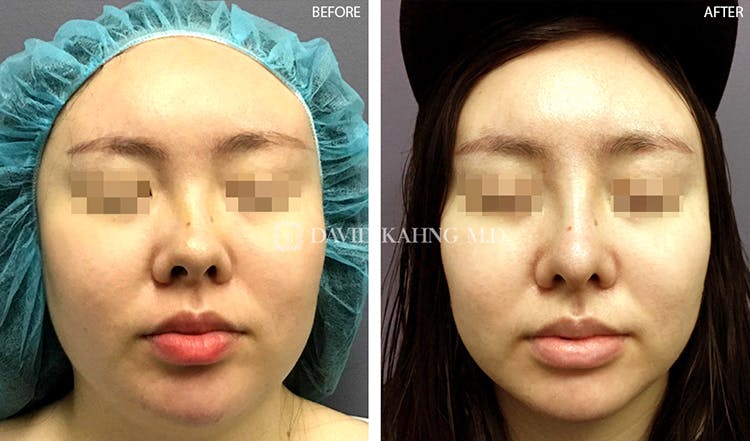 Rhinoplasty Before & After Gallery - Patient 108501447 - Image 2