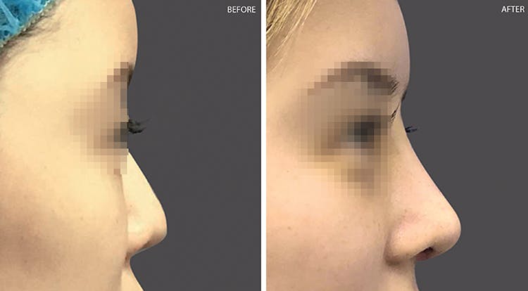 Rhinoplasty Before & After Gallery - Patient 108501449 - Image 1