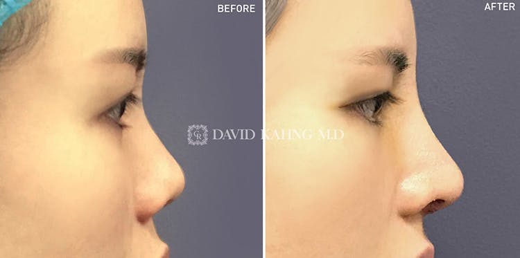 Rhinoplasty Before & After Gallery - Patient 108501450 - Image 1