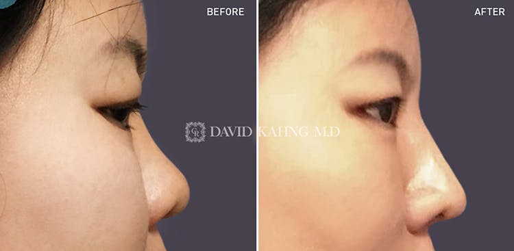 Rhinoplasty Before & After Gallery - Patient 108501451 - Image 1