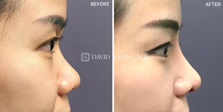 Rhinoplasty Before & After Gallery - Patient 108501452 - Image 1