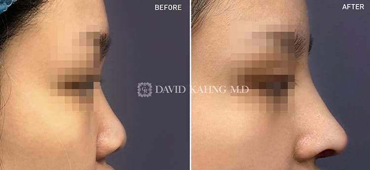 Rhinoplasty Before & After Gallery - Patient 108501453 - Image 1