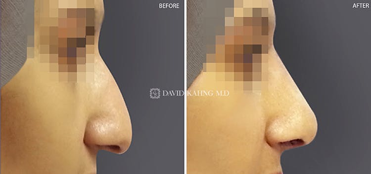 Rhinoplasty Before & After Gallery - Patient 108501454 - Image 1