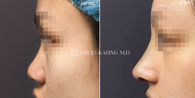 Rhinoplasty Before & After Gallery - Patient 108501459 - Image 1