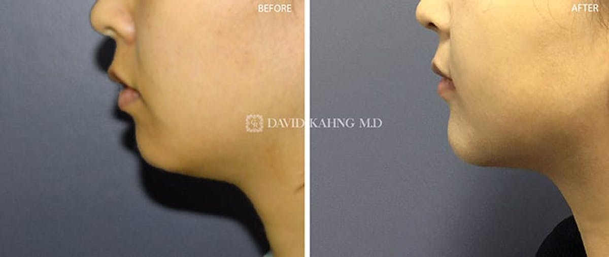 Chin Augmentation Before & After Gallery - Patient 108501504 - Image 1
