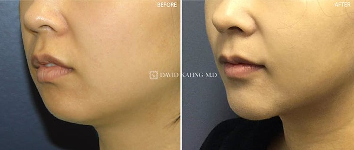 Chin Augmentation Before & After Gallery - Patient 108501504 - Image 2