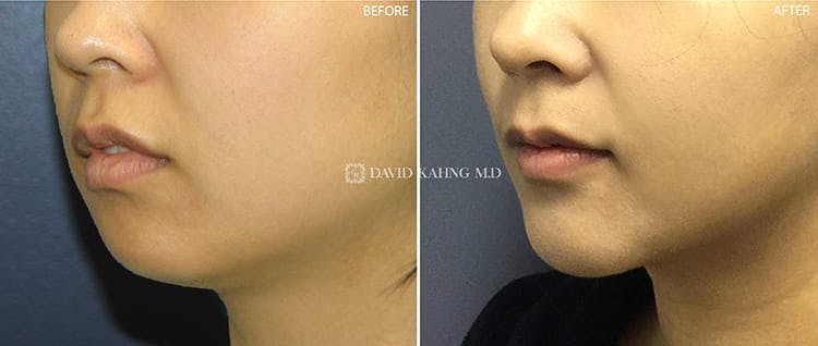 Chin Augmentation Gallery - Patient 108501504 - Image 2