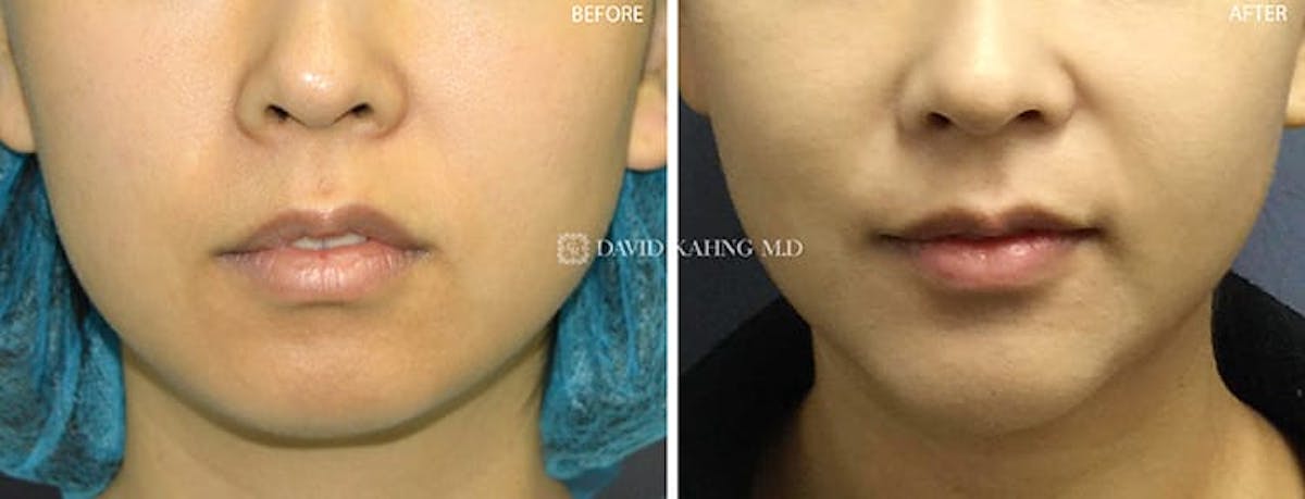 Chin Augmentation Before & After Gallery - Patient 108501504 - Image 3