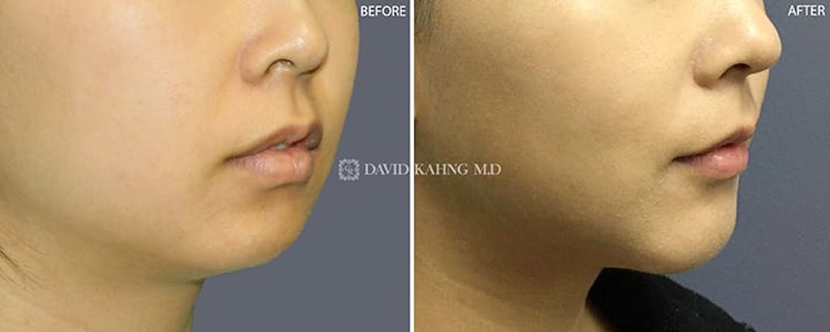 Chin Augmentation Before & After Gallery - Patient 108501504 - Image 4