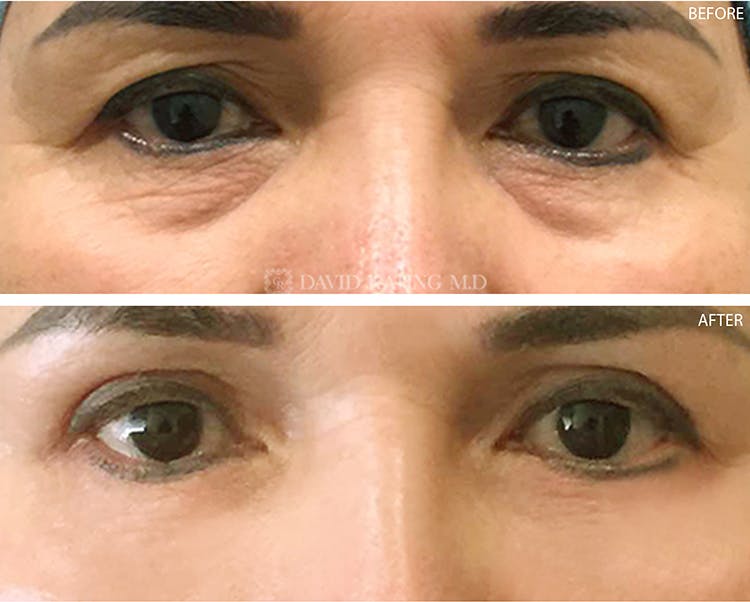 Lower Blepharoplasty Before & After Gallery - Patient 108501512 - Image 1