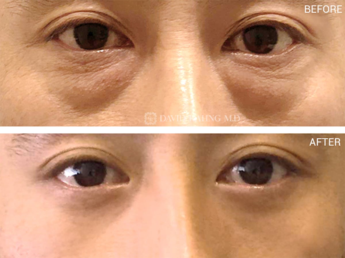 Lower Blepharoplasty Before & After Gallery - Patient 108501511 - Image 1