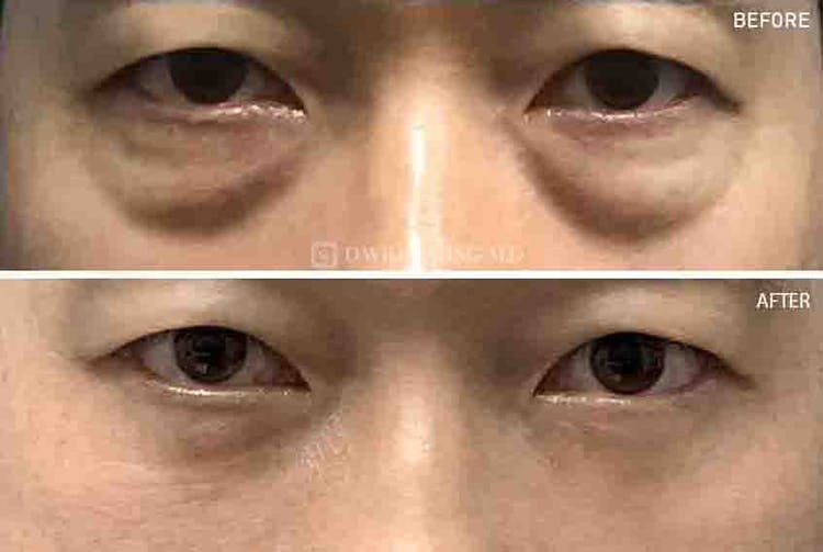 Asian Eyelid Surgery