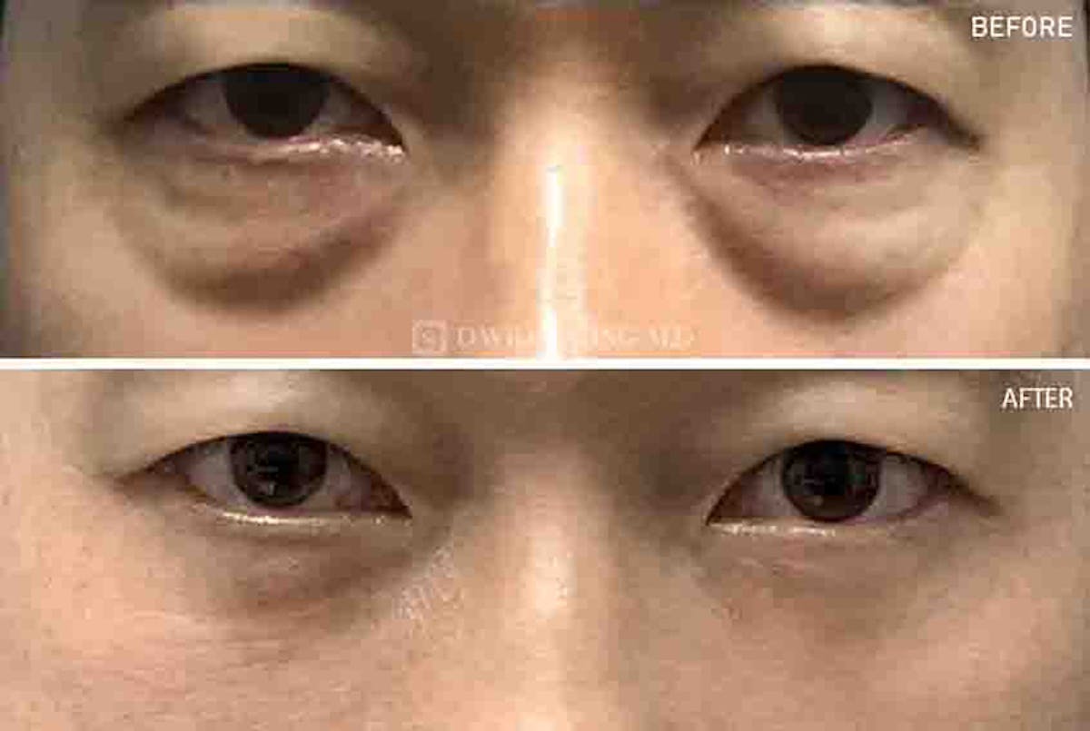 Lower Blepharoplasty Before & After Gallery - Patient 108501510 - Image 1