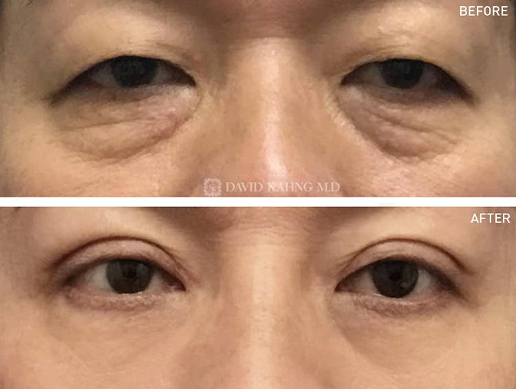 Lower Blepharoplasty Before & After Gallery - Patient 108501509 - Image 1
