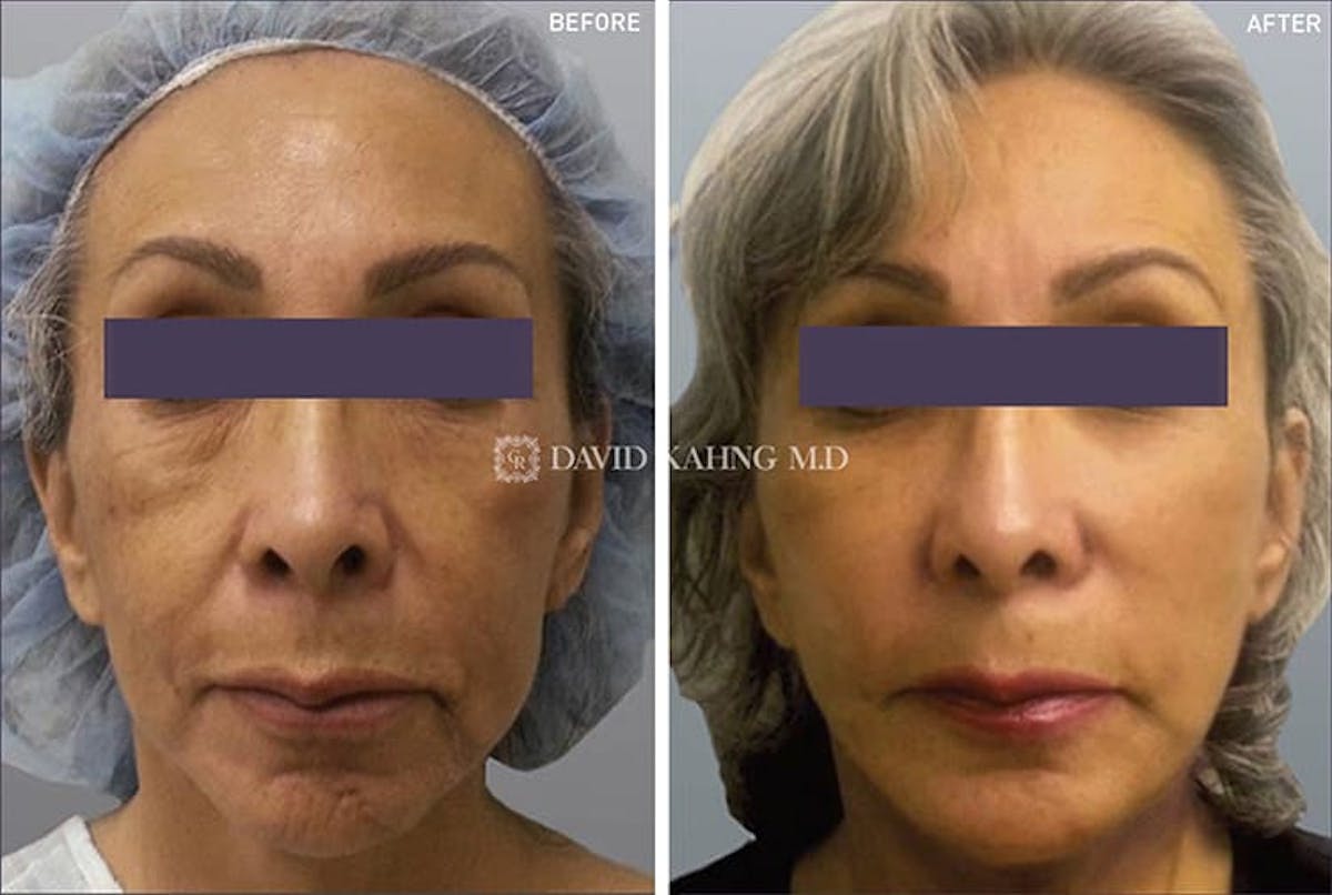 Flanks Before & After Gallery - Bakersfield, CA: Esla Oral & Facial Surgery