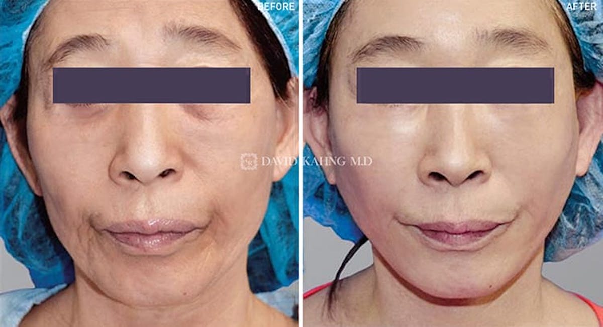 Face Lift Before & After Gallery - Patient 108501516 - Image 1