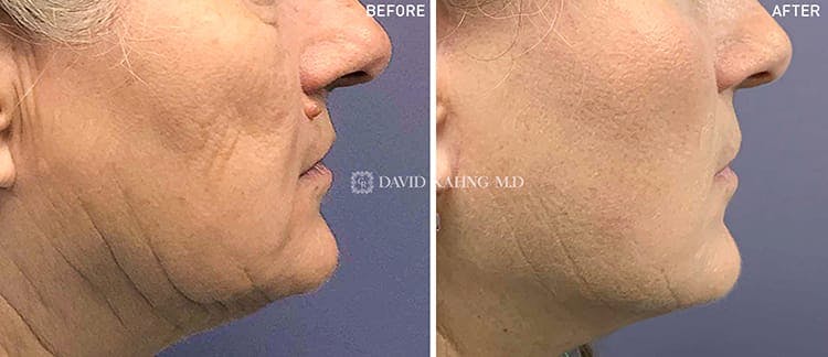 Face Lift Before & After Gallery - Patient 108501517 - Image 1