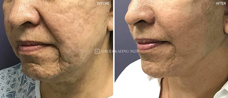 Face Lift Before & After Gallery - Patient 108501518 - Image 1