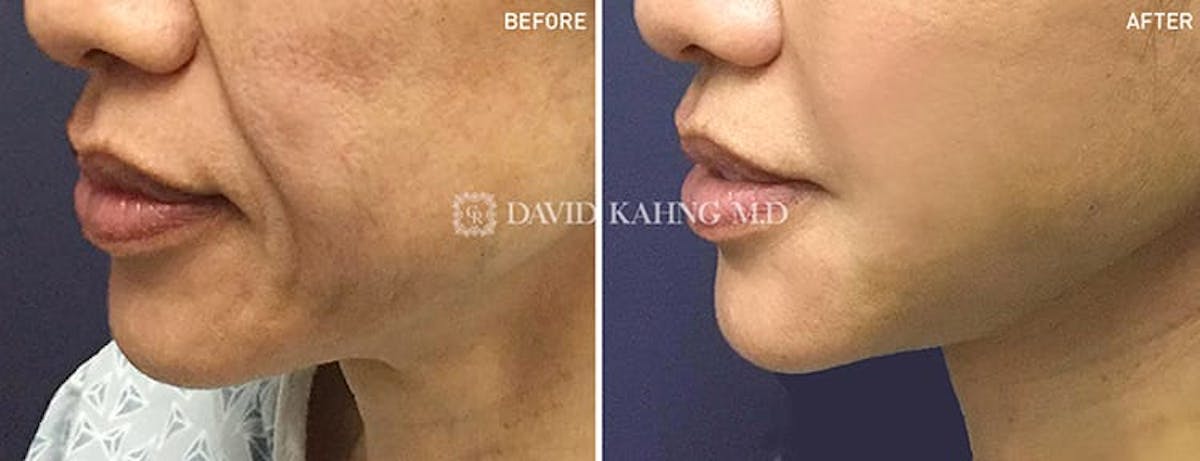 Face Lift Before & After Gallery - Patient 108501519 - Image 1