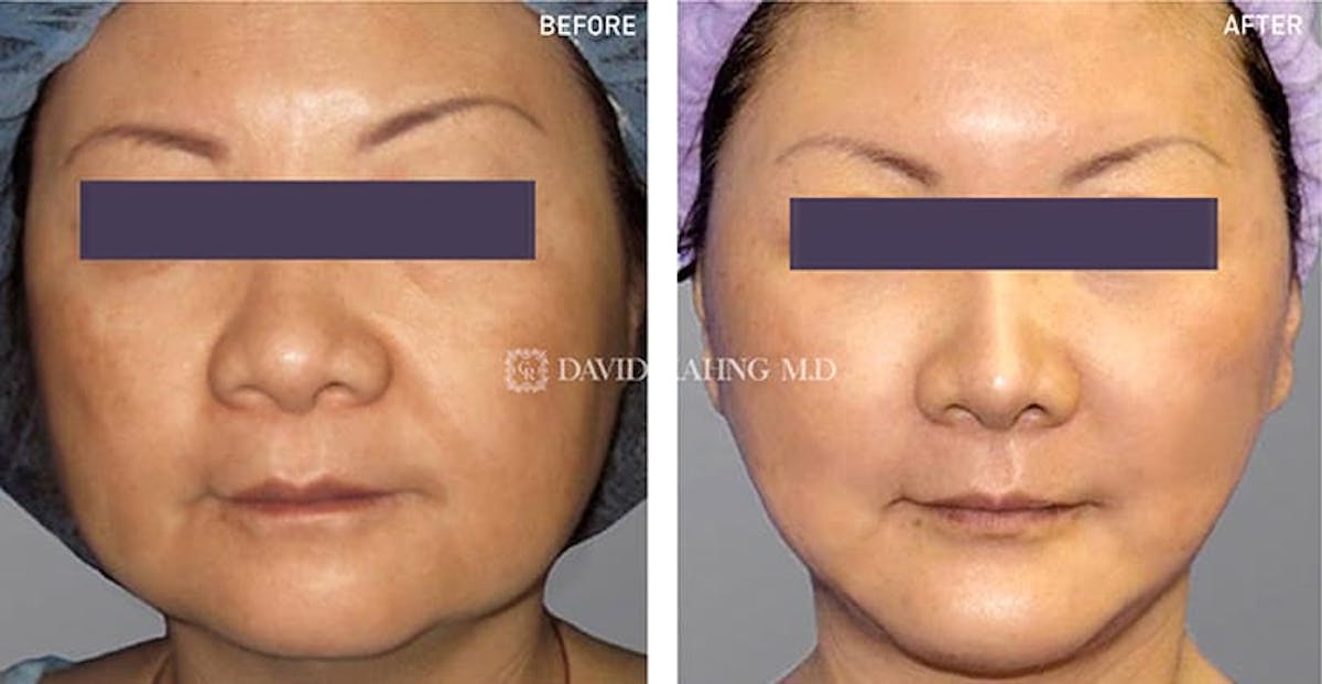 Face Lift Before & After Gallery - Patient 108501514 - Image 1