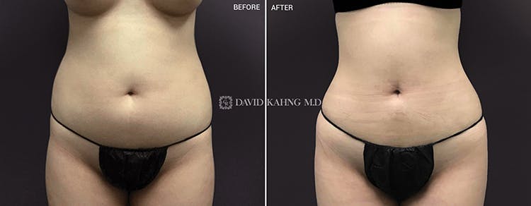 Liposuction Before & After Gallery - Patient 108501623 - Image 1