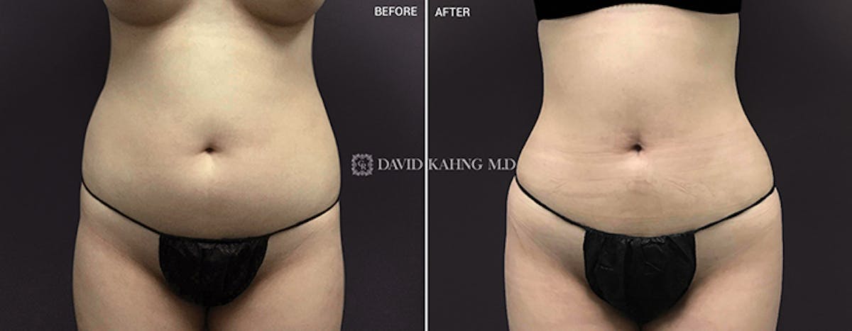 Liposuction Before & After Gallery - Patient 108501623 - Image 1