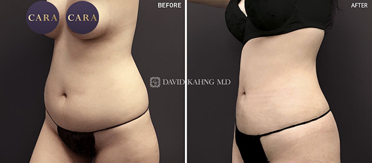 Liposuction Before & After Gallery - Patient 108501623 - Image 2