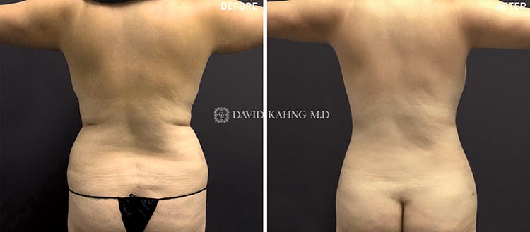 Liposuction Before & After Gallery - Patient 108501624 - Image 1